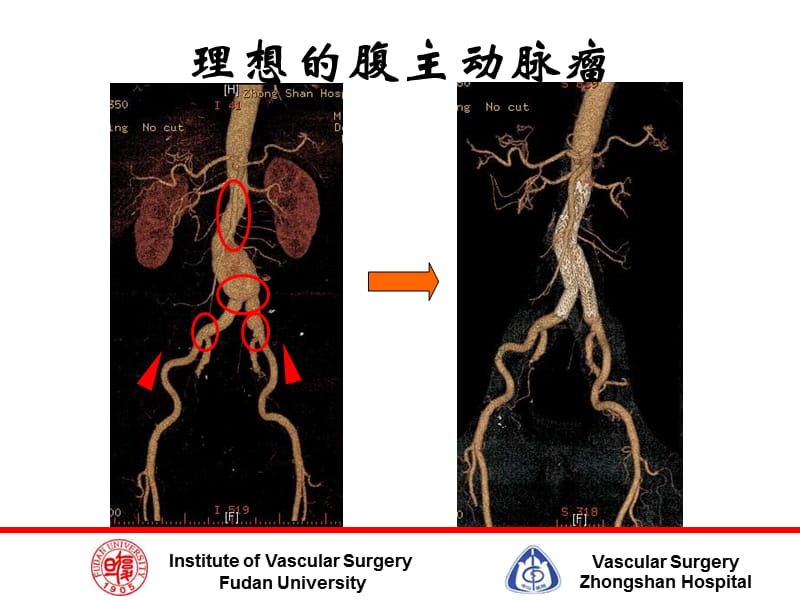 最新腹主动脉瘤EVAR术中陷阱及规避技巧-PPT文档.ppt_第3页