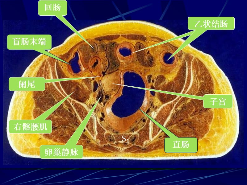 最新女性盆部断面解剖-PPT文档.ppt_第3页