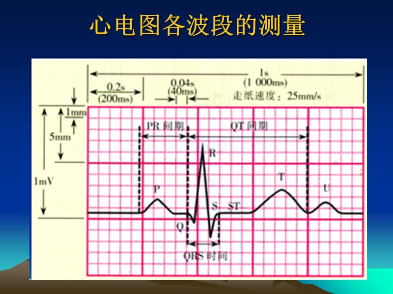 最新：②正常心电图及测量-文档资料.ppt_第3页