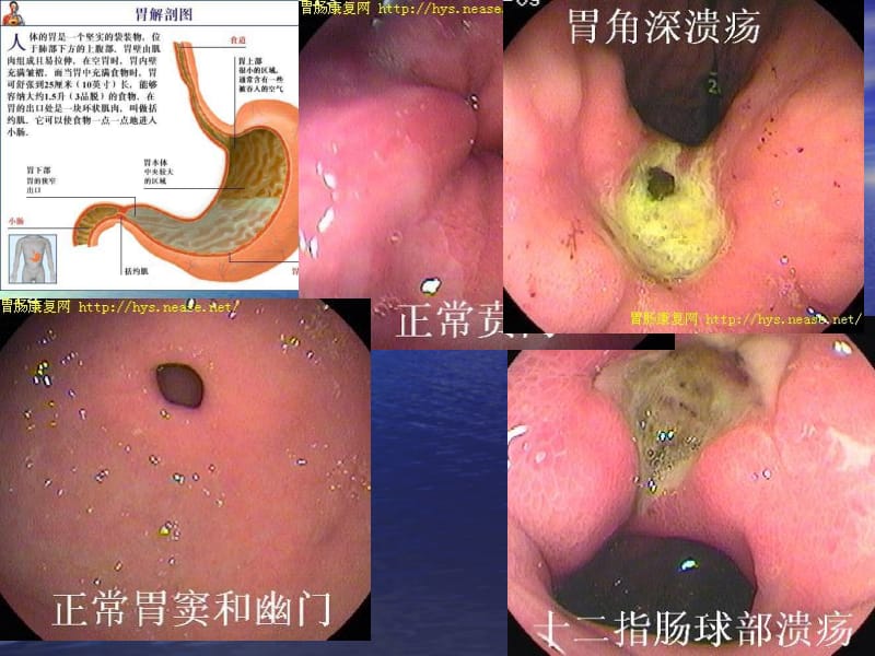 最新：37胃十二指肠疾病-文档资料.ppt_第3页