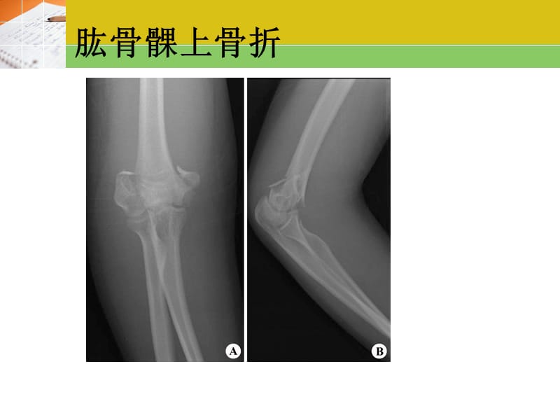 最新《常见疾病x片》ppt课件-PPT文档.ppt_第2页