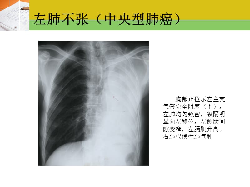 最新《常见疾病x片》ppt课件-PPT文档.ppt_第3页