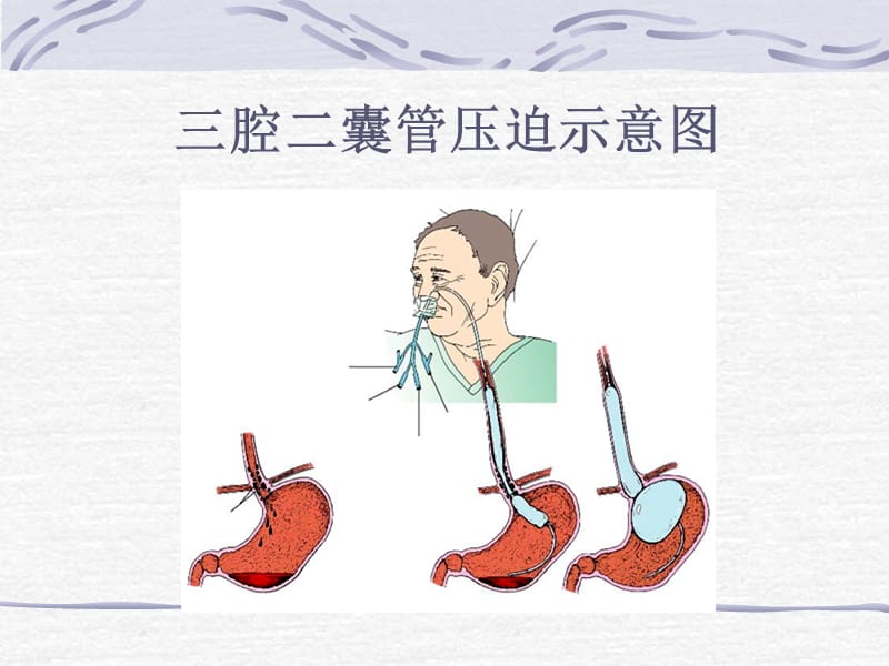 最新：三腔二囊管的应用和护理ppt课件-文档资料.ppt_第1页