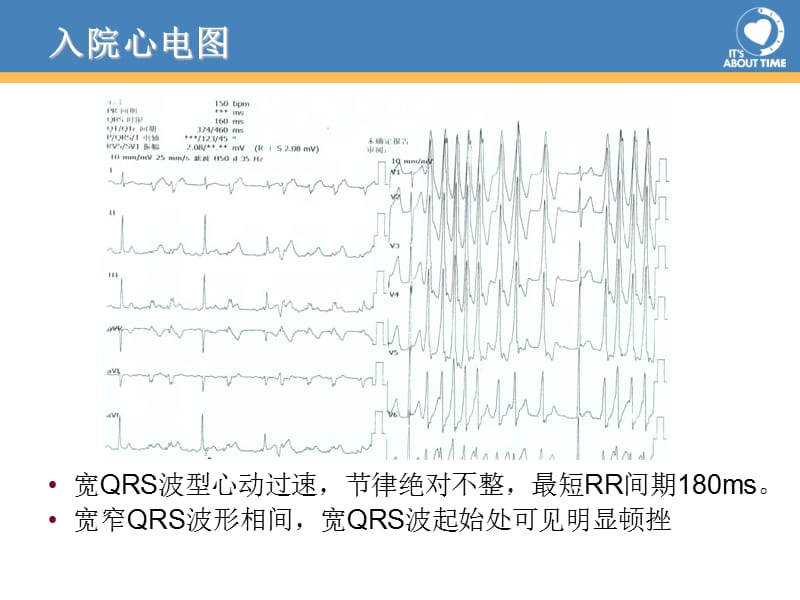 最新经桡动脉消融左侧显预激合并房颤一例-PPT文档.ppt_第2页