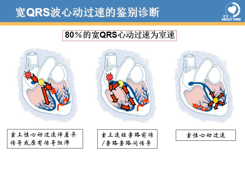 最新经桡动脉消融左侧显预激合并房颤一例-PPT文档.ppt_第3页