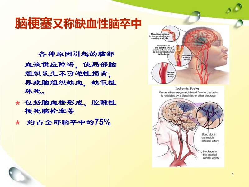 最新：mxd脑梗塞的诊治-文档资料.ppt_第1页