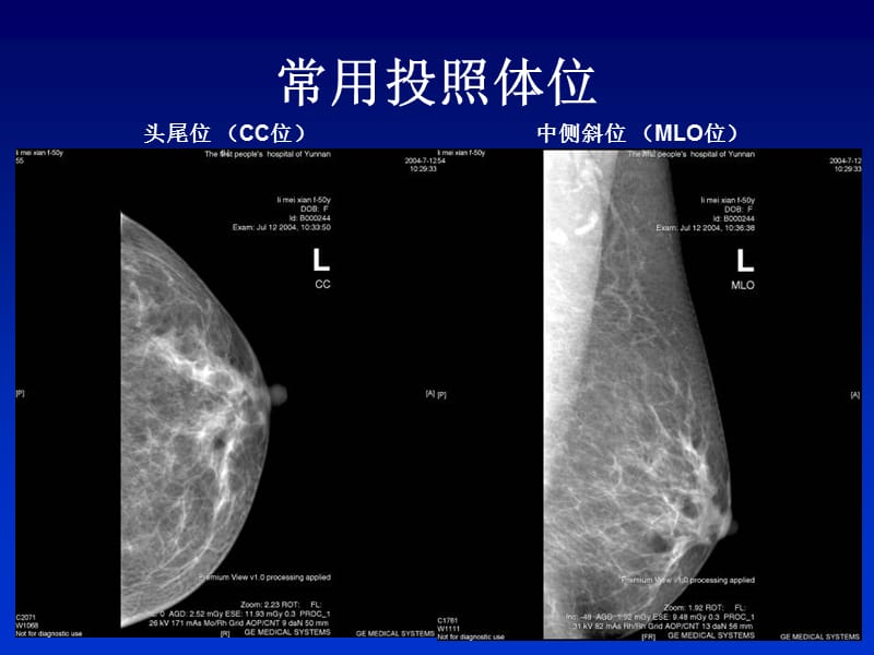 全数字化乳腺机的临床应用-PPT文档.ppt_第2页