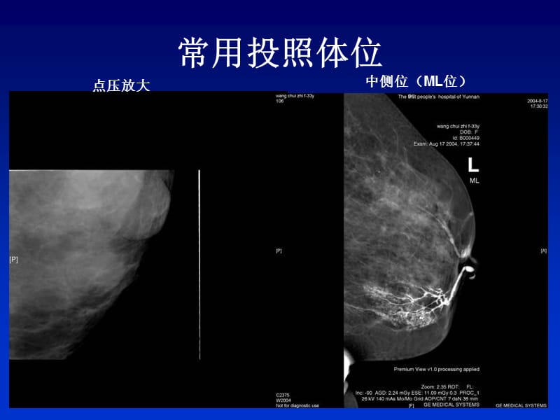 全数字化乳腺机的临床应用-PPT文档.ppt_第3页