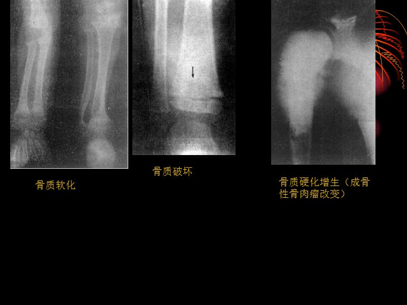 普通x线骨骼系统影像表现-文档资料.ppt_第3页