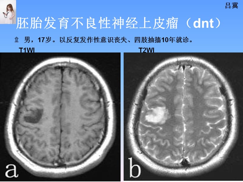 医影在线--CNS疾病影像图库2-PPT课件.ppt_第1页