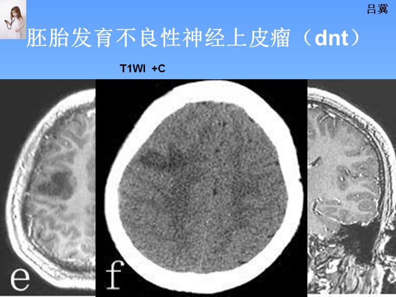 医影在线--CNS疾病影像图库2-PPT课件.ppt_第3页