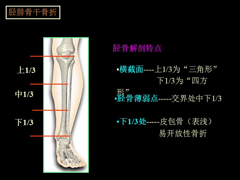 最新胫腓骨骨折手法整复-PPT文档.ppt_第1页