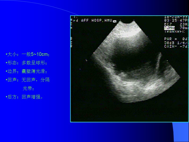 最新卵巢肿瘤2-PPT文档.ppt_第3页