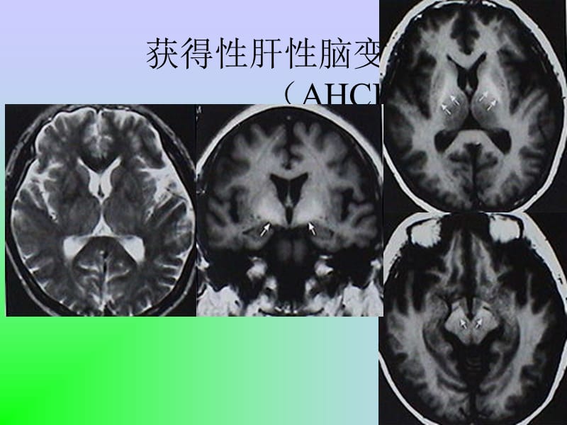 最新脑变性和脑白质病-PPT文档.ppt_第1页