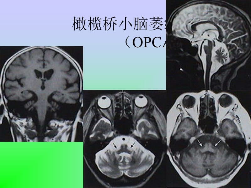 最新脑变性和脑白质病-PPT文档.ppt_第2页