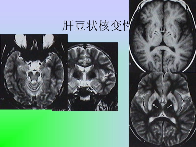 最新脑变性和脑白质病-PPT文档.ppt_第3页