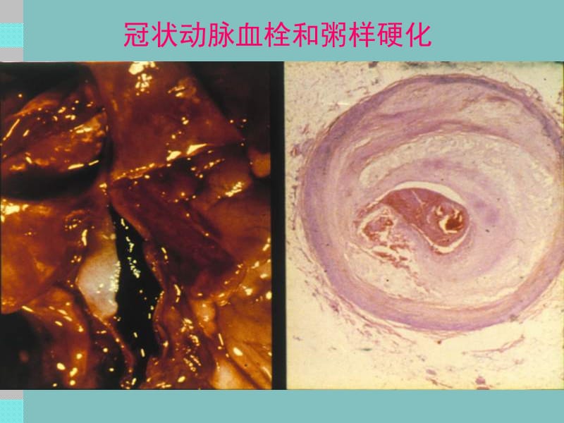 最新：【医药健康】冠状动脉粥样硬化性心脏病(CHD)-文档资料.ppt_第2页