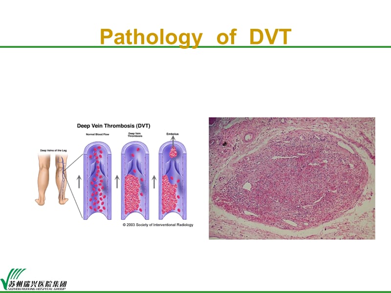 最新下肢深静脉血栓形成防治-PPT文档.ppt_第3页