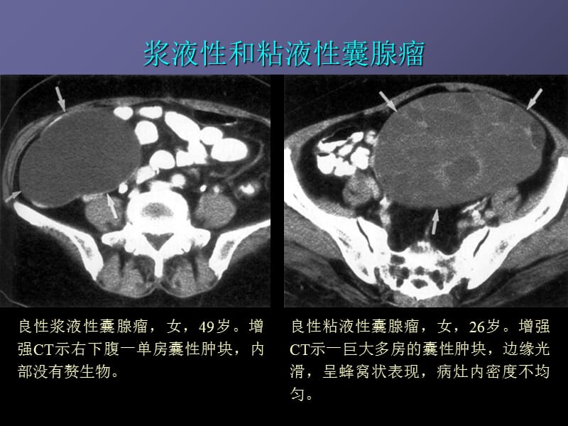 卵巢肿瘤的影像学表现-PPT课件.ppt_第3页