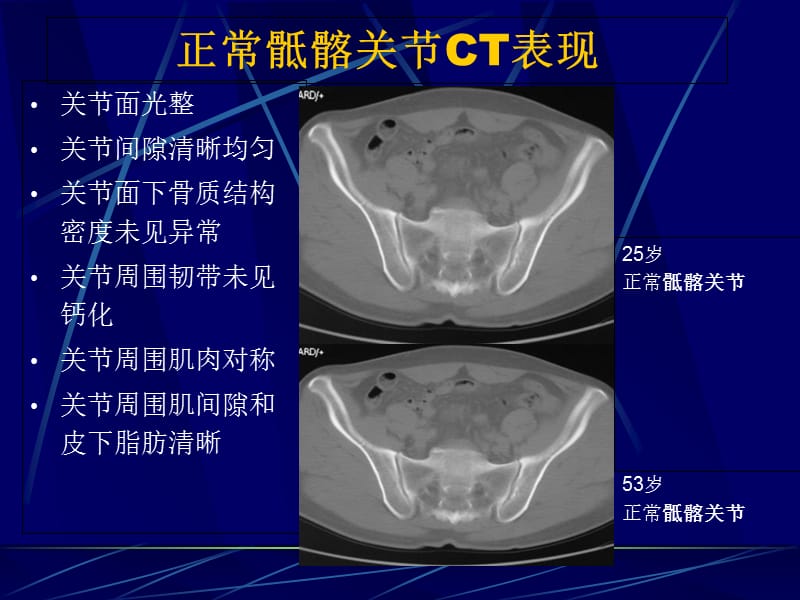 AS骶髂关节病变的CT诊断-文档资料.ppt_第2页