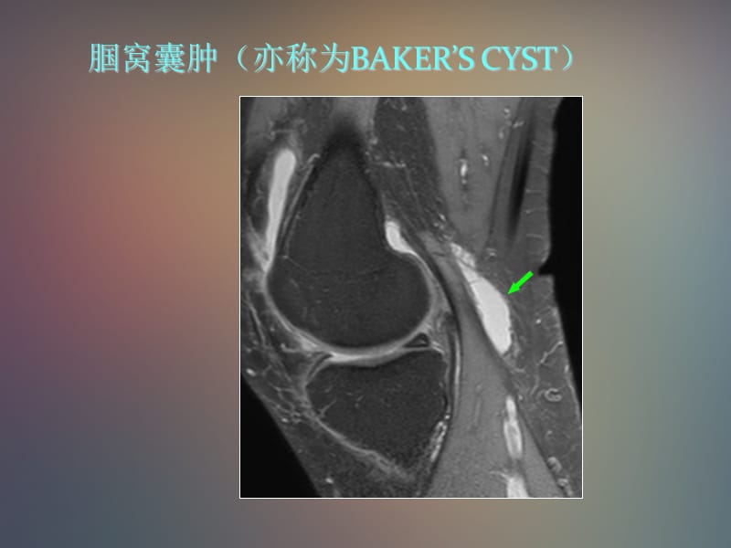 最新膝关节囊性损伤和滑膜病变-PPT文档.ppt_第3页