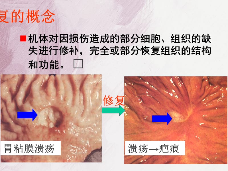 最新：病理学损伤修复(修改)-文档资料.ppt_第3页