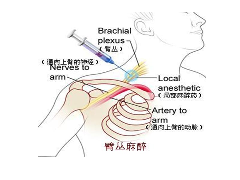最新超声引导上肢神经阻滞-PPT文档.ppt_第2页
