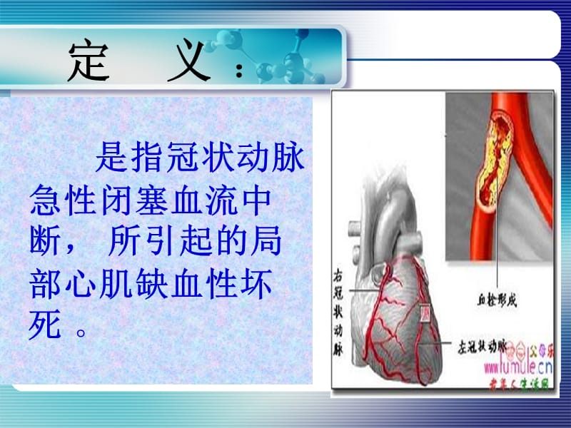 急性心肌梗死抢救护理-PPT文档资料.ppt_第2页