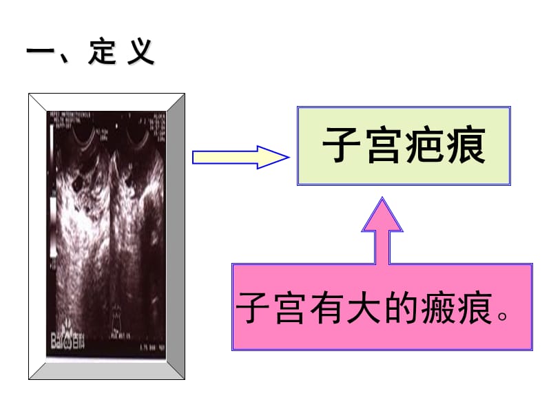 疤痕子宫再次妊娠有关问题的探讨-精选文档.ppt_第2页