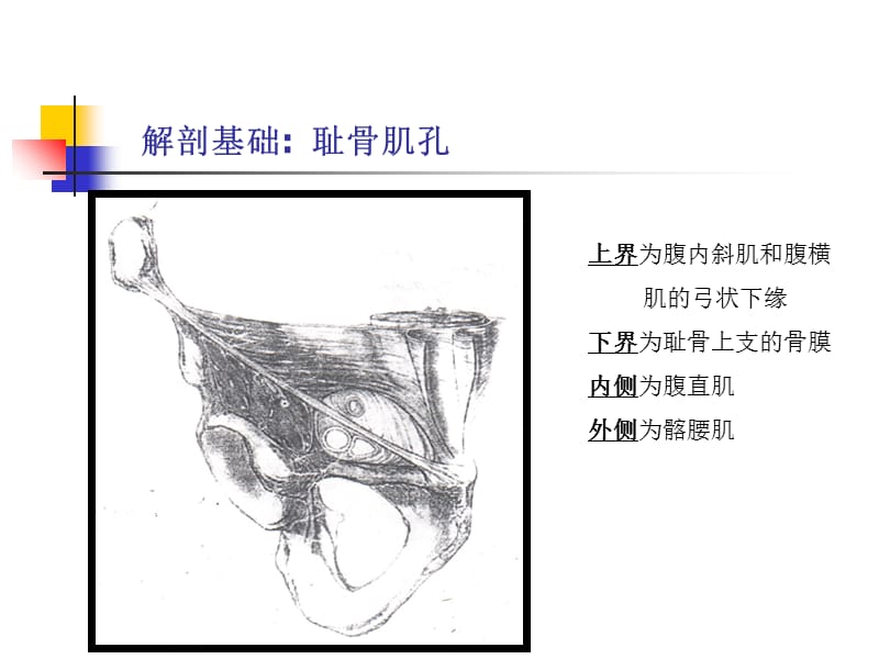 最新：TEP手术过程详解课件-文档资料.ppt_第2页