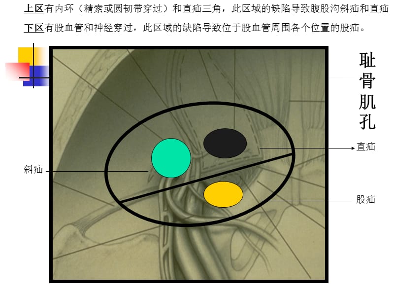 最新：TEP手术过程详解课件-文档资料.ppt_第3页