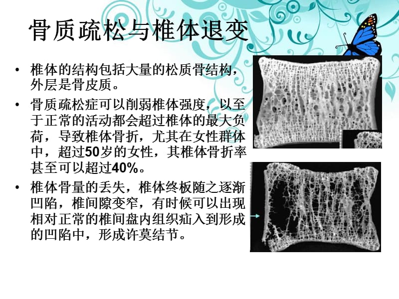 浅谈椎体成形术在骨质疏松性椎体压缩骨折中的应用-精选文档.ppt_第3页