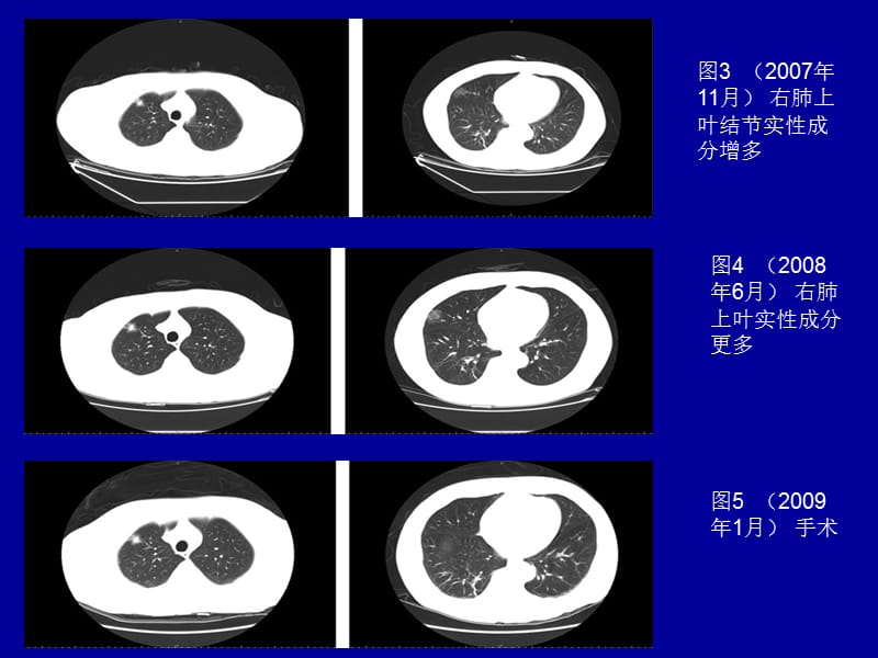 最新：亚实性结节和临床决策-文档资料.ppt_第2页