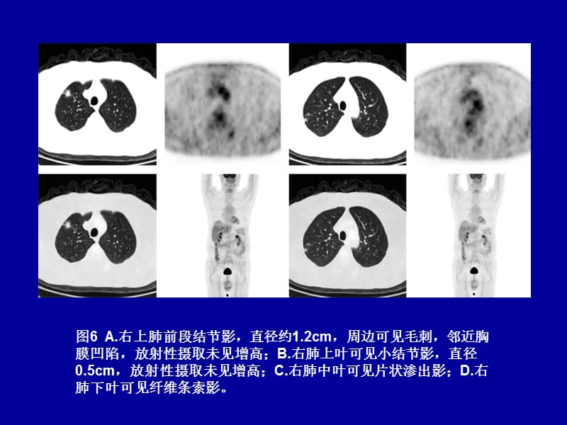 最新：亚实性结节和临床决策-文档资料.ppt_第3页