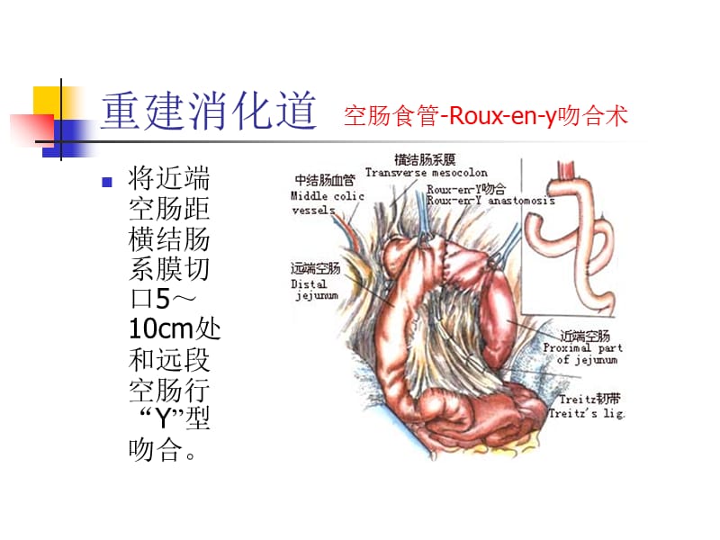 图解全胃切除手术三-精选文档.ppt_第1页