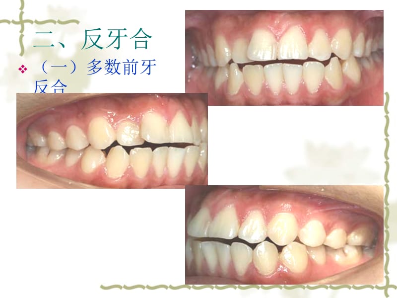 口腔正畸学第八章常见错合畸形的矫治二反合-文档资料.ppt_第1页