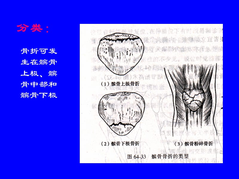 最新：外科学多媒体课件 髌骨骨折-文档资料.ppt_第2页