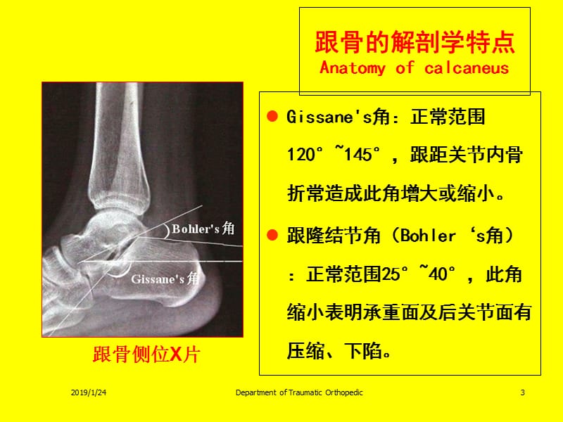 最新：樊仕才 金大地 跟骨骨折的分型和治疗课件-文档资料.ppt_第3页