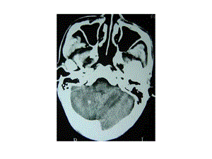 多发性颅内转移瘤并出血-PPT文档资料.ppt