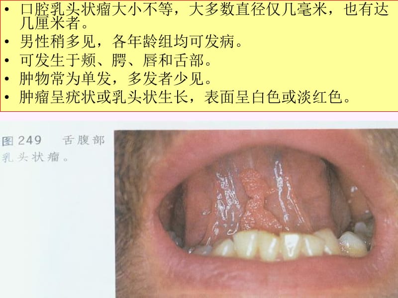 口腔颌面部其他组织来源的肿瘤-PPT课件.ppt_第2页