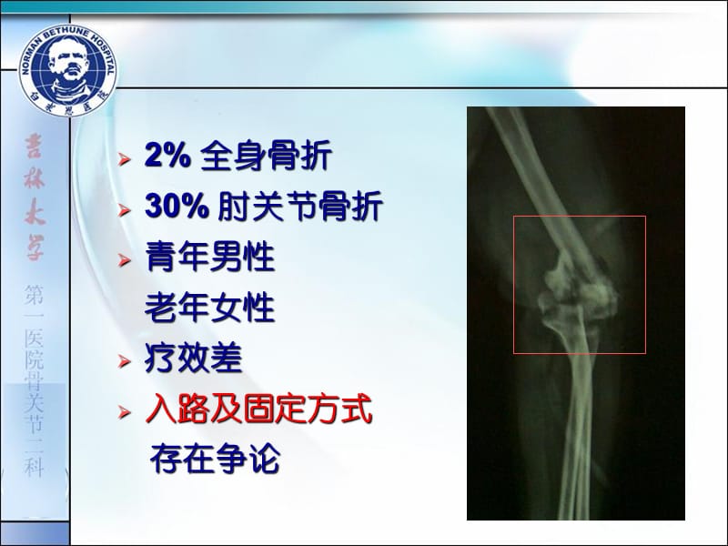 复杂肱骨远端关节内骨折手术入路及固定方式的选择-文档资料.ppt_第1页