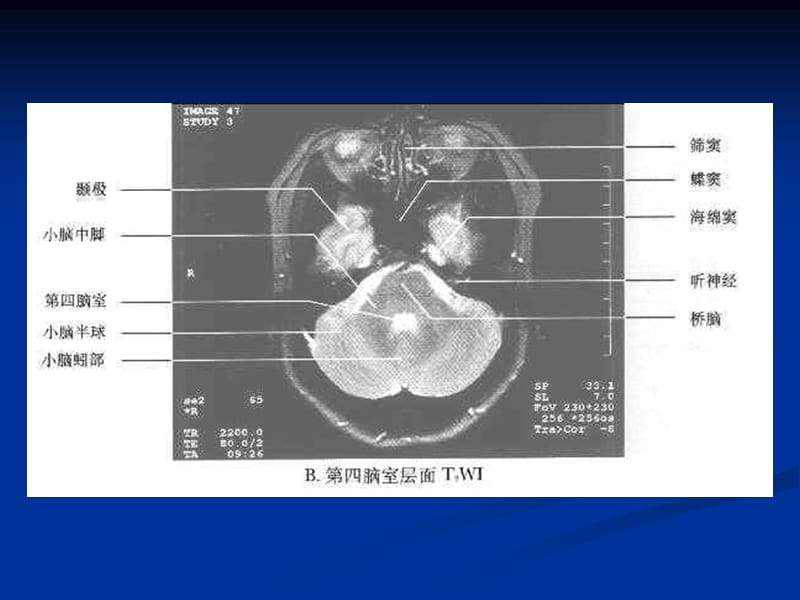 枢神经系统常见肿瘤的mri诊断-精选文档.ppt_第2页