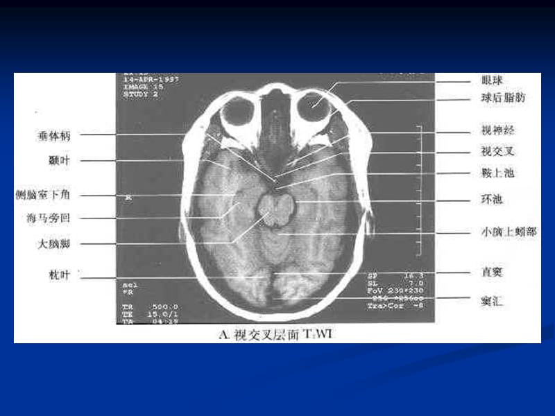 枢神经系统常见肿瘤的mri诊断-精选文档.ppt_第3页