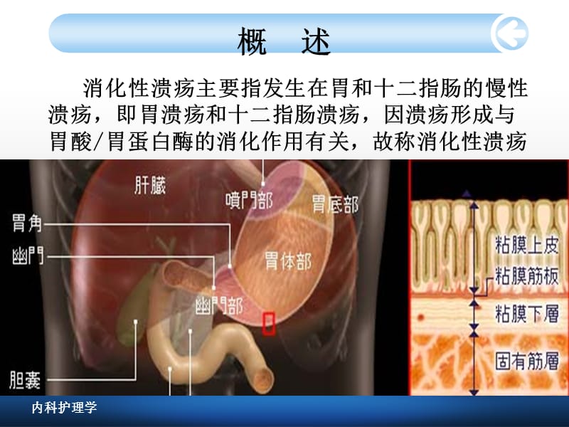 消化性溃疡病人的护理-PPT文档.ppt_第3页