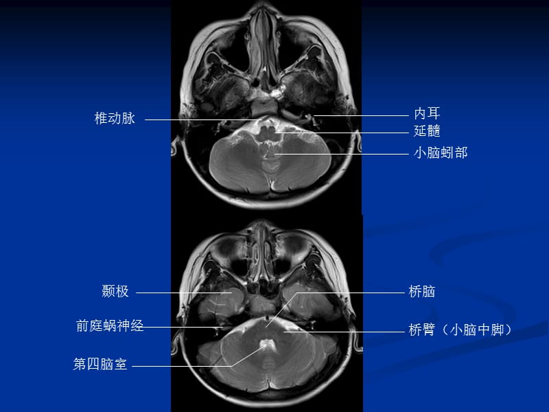 头颅CT和MRI的正常图像课件-PPT文档资料.ppt_第2页