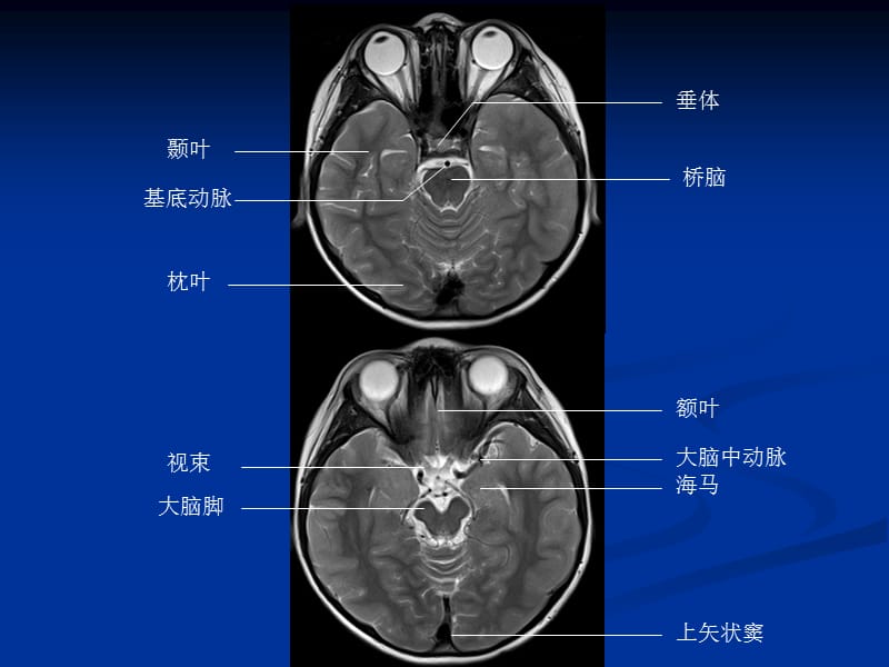 头颅CT和MRI的正常图像课件-PPT文档资料.ppt_第3页