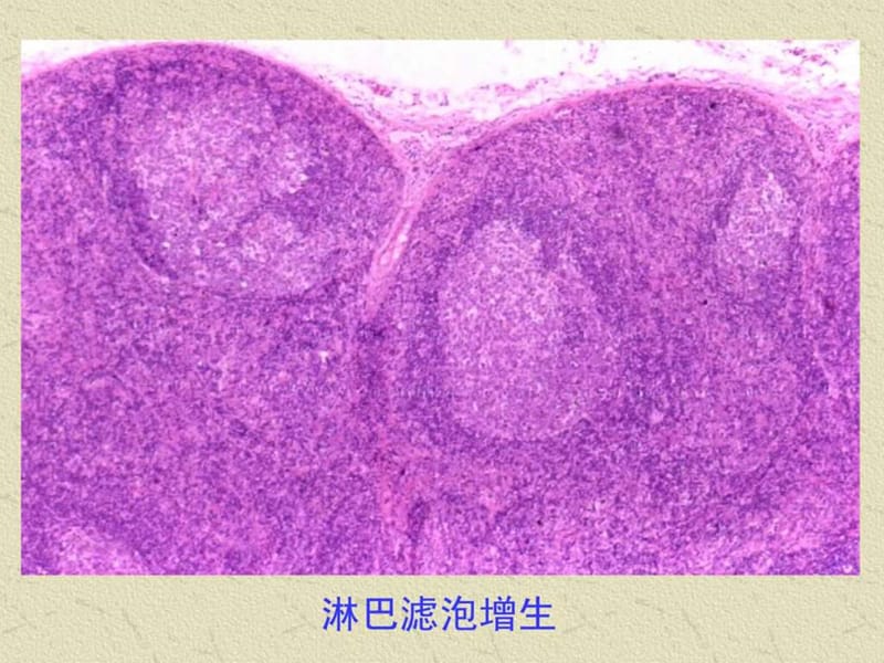 最新：淋巴和造血系统疾病-文档资料.ppt_第3页