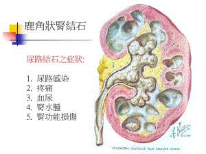 台湾地区上路结石流行病学-PPT文档资料.ppt