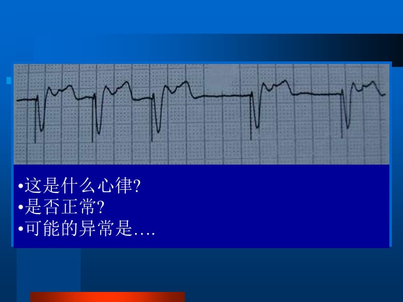 最新起搏器诊断功能应用-PPT文档.ppt_第3页