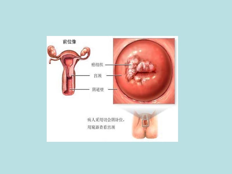 宫颈癌床诊断及分期-PPT文档资料.ppt_第1页